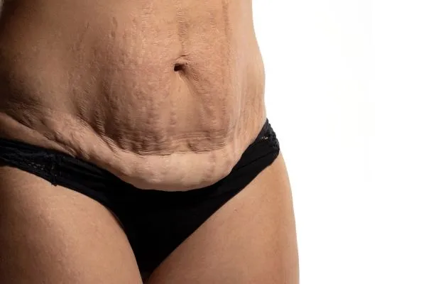 The Science of Skin Tightening 1 The science behind skin tightening Northamptonshire picture of a woman's sagging skin on the stomach
